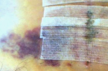 Lower part of incision showing extra goopy part under the steri-strips